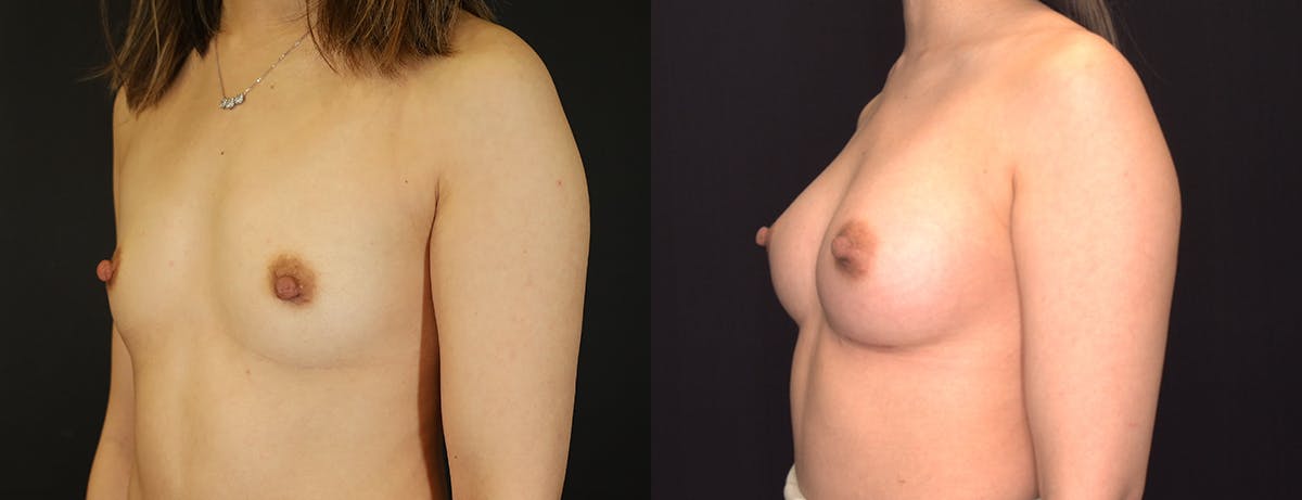 Breast Augmentation Before & After Gallery - Patient 410813 - Image 2
