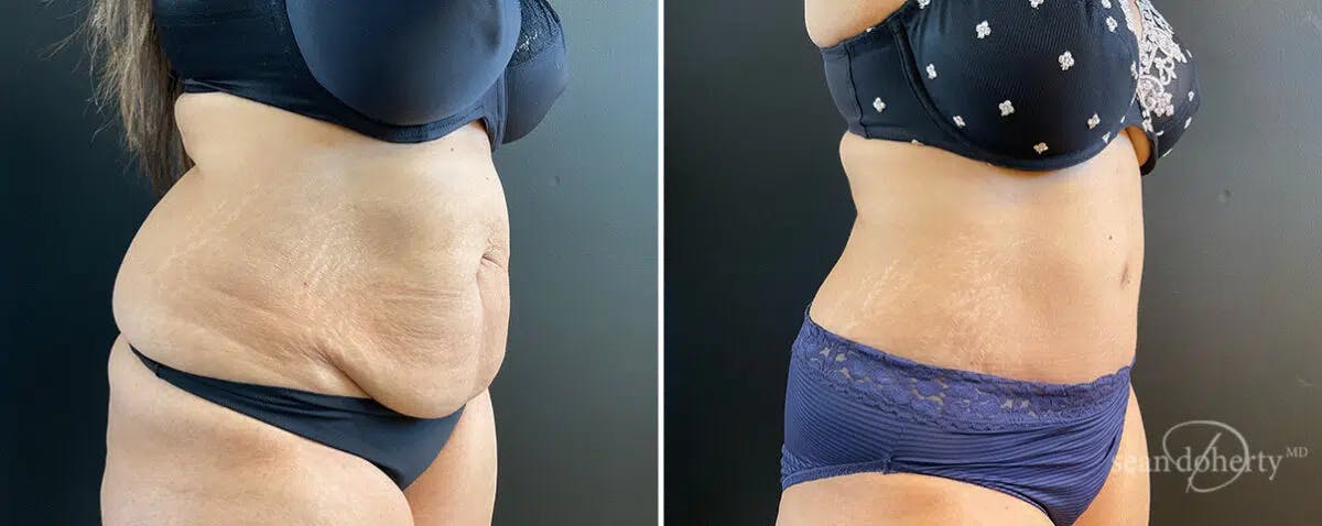 Abdominoplasty (Tummy Tuck) Before & After Gallery - Patient 326164 - Image 2