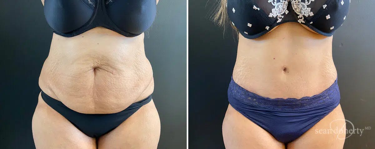 Abdominoplasty (Tummy Tuck) Before & After Gallery - Patient 326164 - Image 1