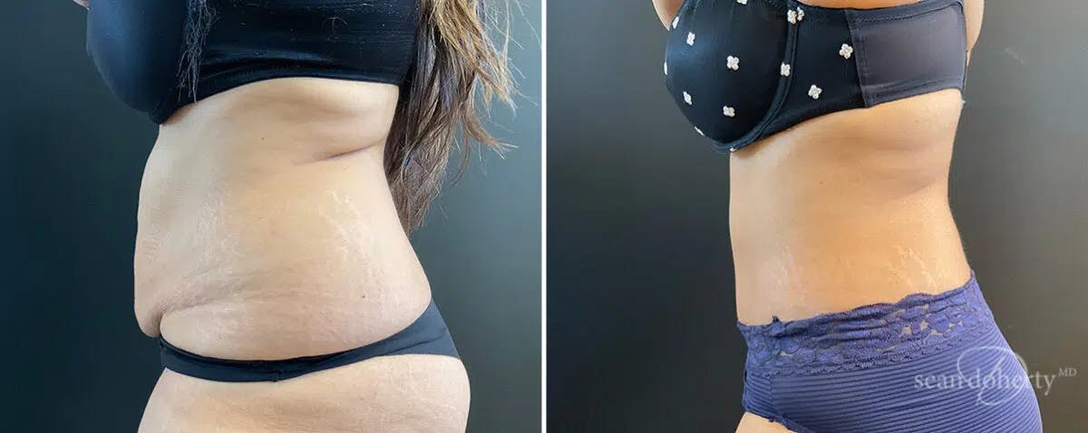 Abdominoplasty (Tummy Tuck) Before & After Gallery - Patient 326164 - Image 3