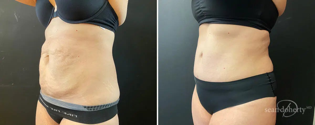 Abdominoplasty (Tummy Tuck) Before & After Gallery - Patient 312378 - Image 3