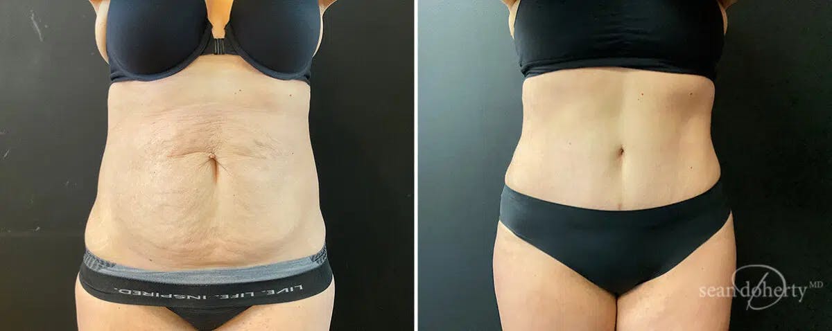 Abdominoplasty (Tummy Tuck) Before & After Gallery - Patient 312378 - Image 1