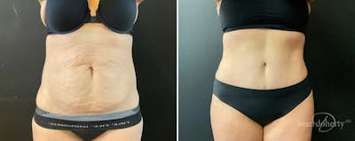 Abdominoplasty (Tummy Tuck) Before & After Gallery - Patient 312378 - Image 1