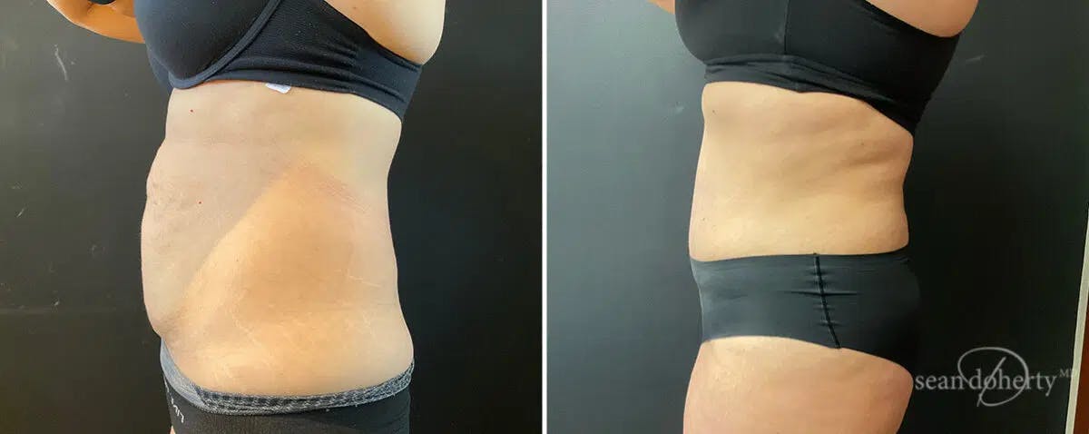 Abdominoplasty (Tummy Tuck) Before & After Gallery - Patient 312378 - Image 2