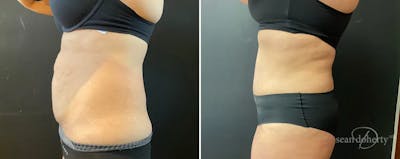 Abdominoplasty (Tummy Tuck) Before & After Gallery - Patient 312378 - Image 2