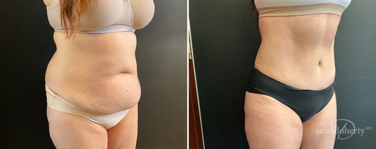 Abdominoplasty (Tummy Tuck) Before & After Gallery - Patient 144563 - Image 3