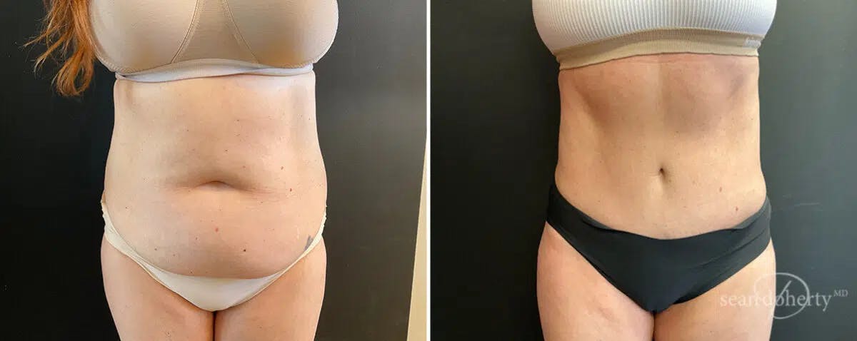 Abdominoplasty (Tummy Tuck) Before & After Gallery - Patient 144563 - Image 1