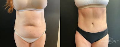 Abdominoplasty (Tummy Tuck) Before & After Gallery - Patient 144563 - Image 1