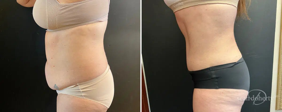 Abdominoplasty (Tummy Tuck) Before & After Gallery - Patient 144563 - Image 2