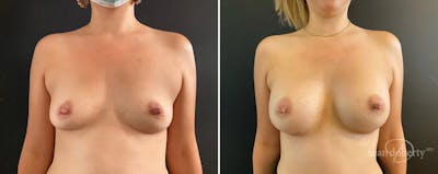 Breast Augmentation Before & After Gallery - Patient 300286 - Image 1
