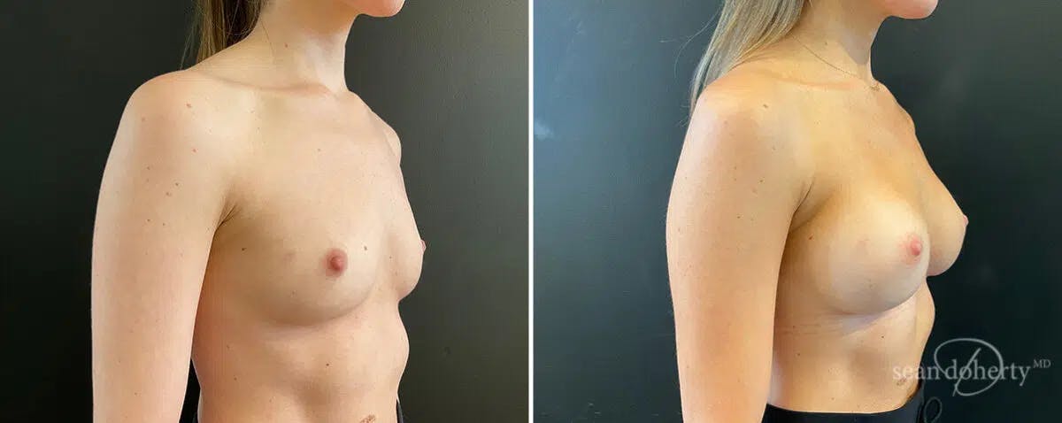 Breast Augmentation Before & After Gallery - Patient 294285 - Image 3