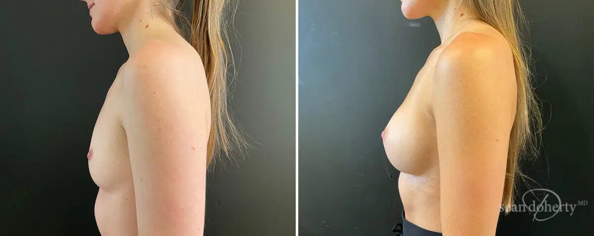Breast Augmentation Before & After Gallery - Patient 294285 - Image 2