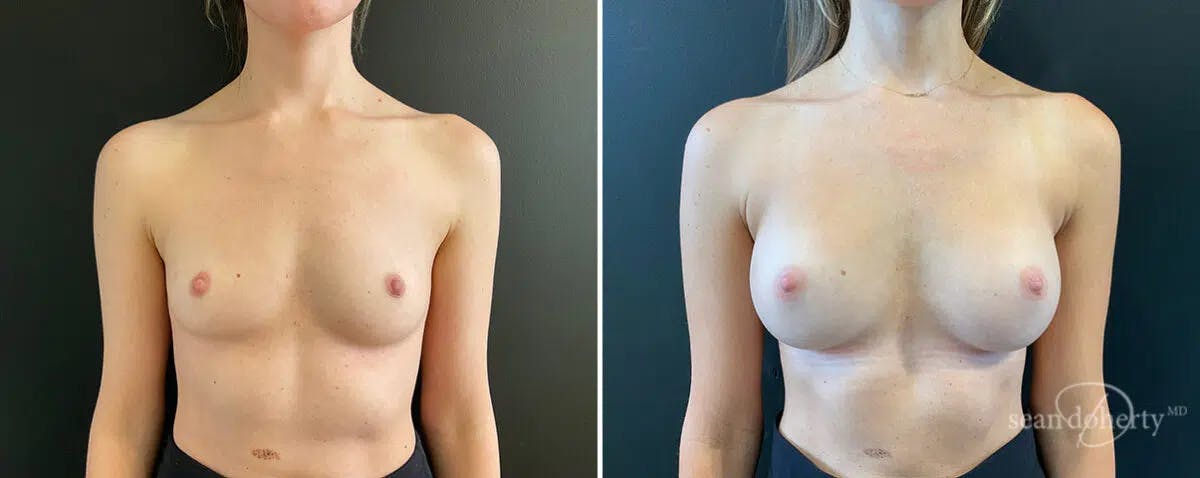 Breast Augmentation Before & After Gallery - Patient 294285 - Image 1