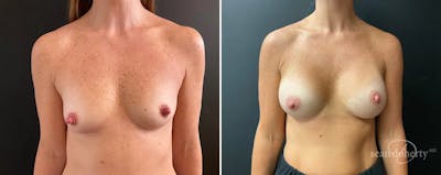 Breast Augmentation Before & After Gallery - Patient 217754 - Image 1