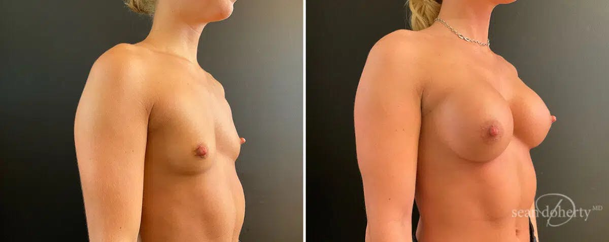 Breast Augmentation Before & After Gallery - Patient 111760 - Image 2