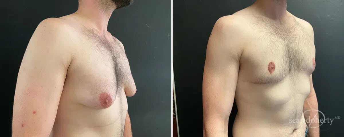 Male Breast Reduction (Gynecomastia) Before & After Gallery - Patient 235924 - Image 3