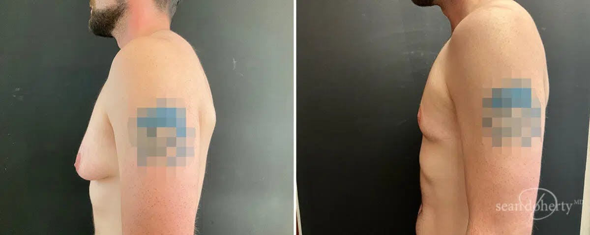 Male Breast Reduction (Gynecomastia) Before & After Gallery - Patient 235924 - Image 2
