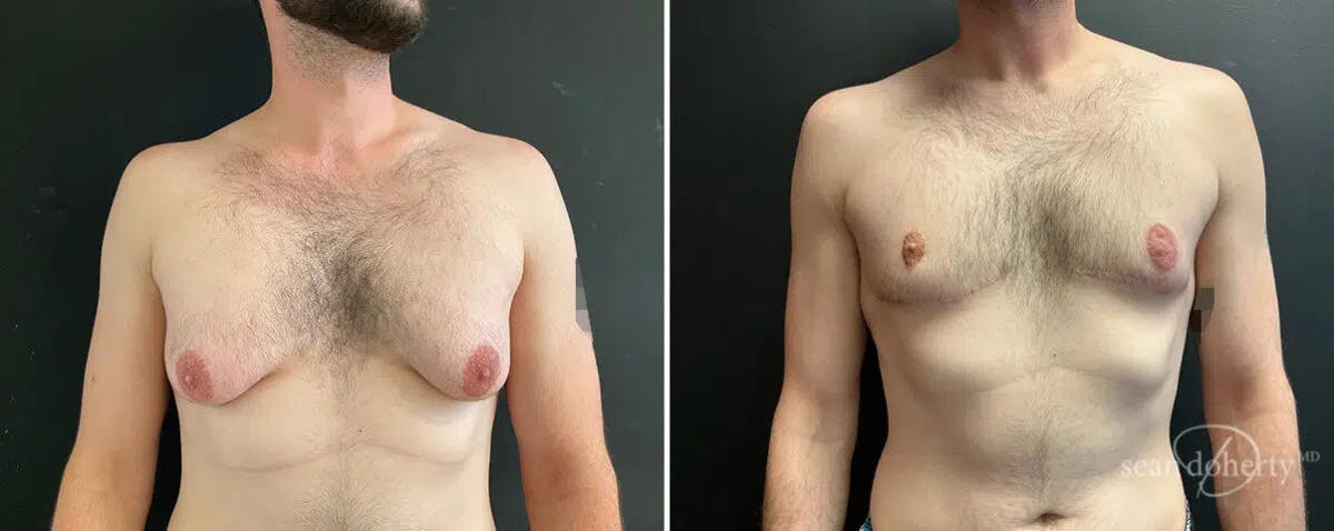 Male Breast Reduction (Gynecomastia) Before & After Gallery - Patient 235924 - Image 1