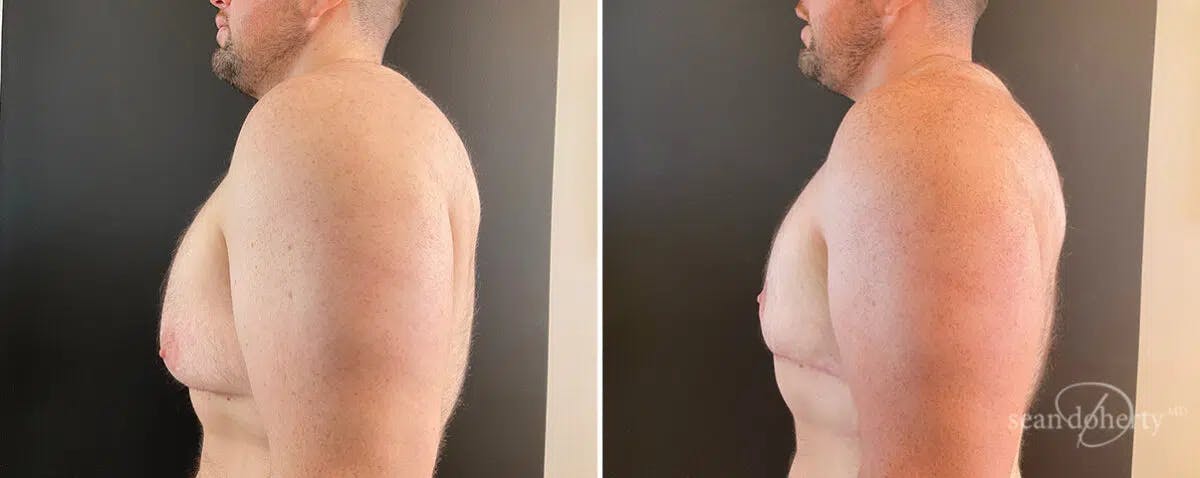 Male Breast Reduction (Gynecomastia) Before & After Gallery - Patient 244729 - Image 3