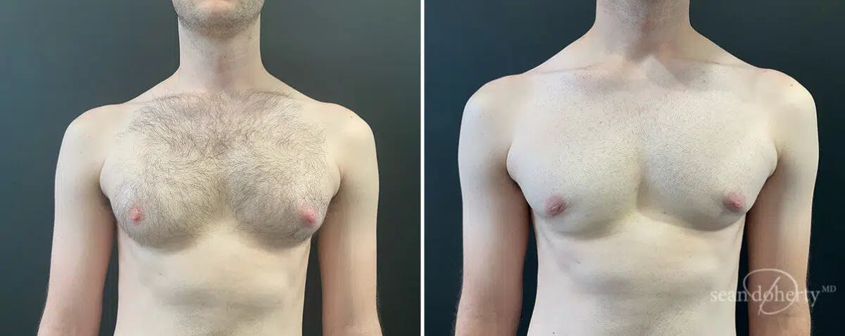 Male Breast Reduction (Gynecomastia) Before & After Gallery - Patient 357881 - Image 2