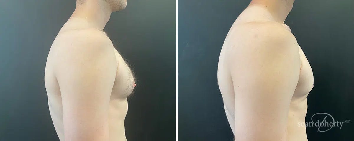 Male Breast Reduction (Gynecomastia) Before & After Gallery - Patient 357881 - Image 1