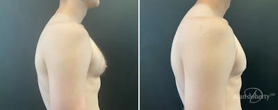 Male Breast Reduction (Gynecomastia) Before & After Gallery - Patient 357881 - Image 1