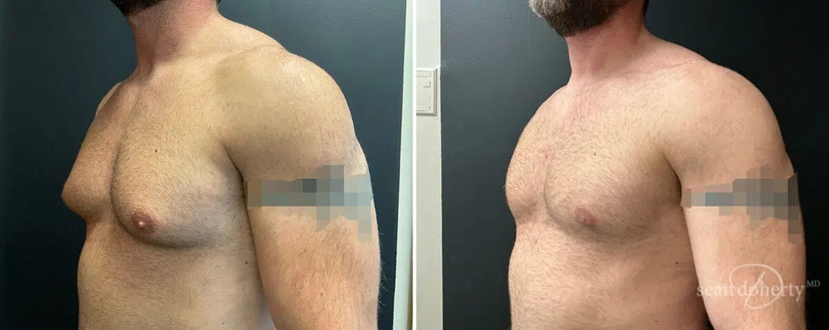 Male Breast Reduction (Gynecomastia) Before & After Gallery - Patient 556576 - Image 3