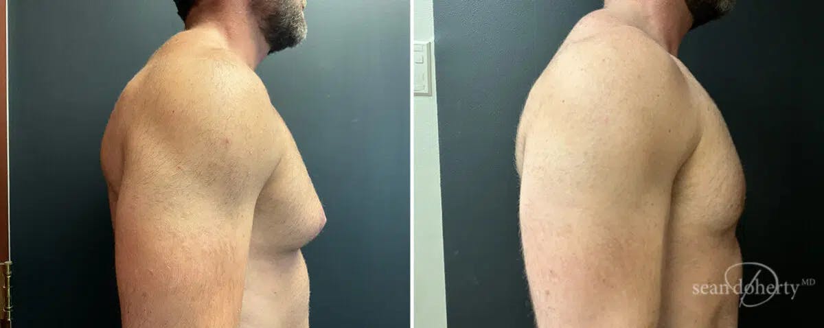 Male Breast Reduction (Gynecomastia) Before & After Gallery - Patient 556576 - Image 2