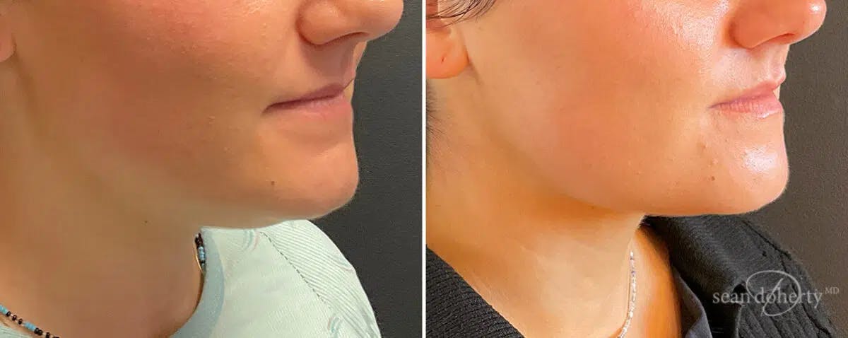 Neck Liposuction Before & After Gallery - Patient 533089 - Image 3
