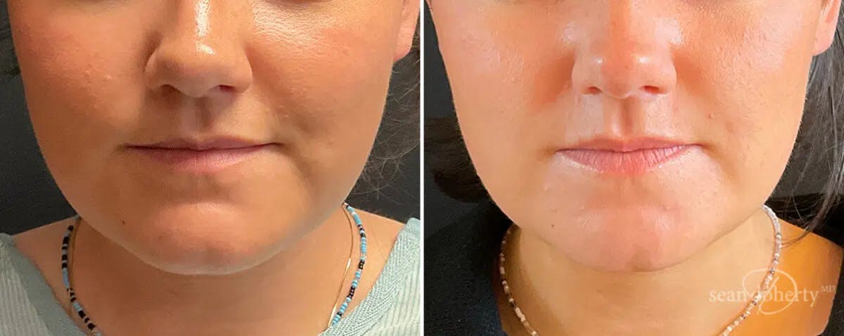 Neck Liposuction Before & After Gallery - Patient 533089 - Image 2