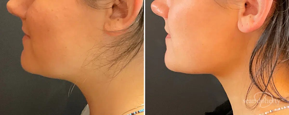 Neck Liposuction Before & After Gallery - Patient 533089 - Image 1