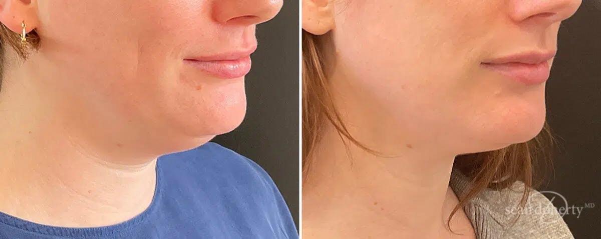 Neck Liposuction Before & After Gallery - Patient 120991 - Image 2