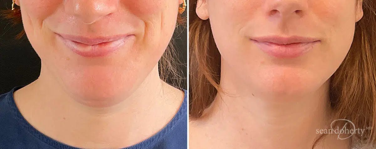 Neck Liposuction Before & After Gallery - Patient 120991 - Image 3