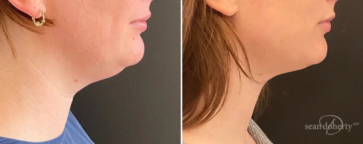 Neck Liposuction Before & After Gallery - Patient 120991 - Image 1
