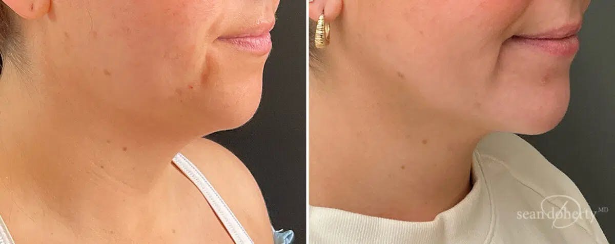 Neck Liposuction Before & After Gallery - Patient 346077 - Image 3