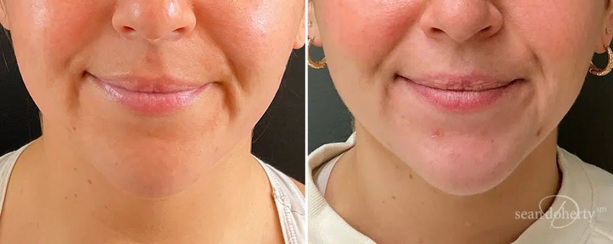Neck Liposuction Before & After Gallery - Patient 346077 - Image 2