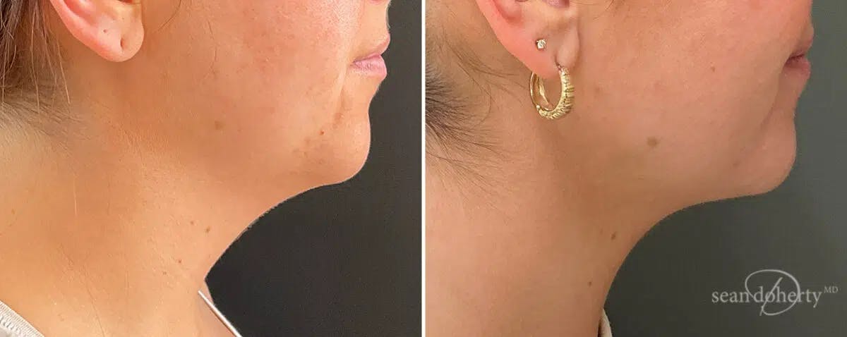 Neck Liposuction Before & After Gallery - Patient 346077 - Image 1