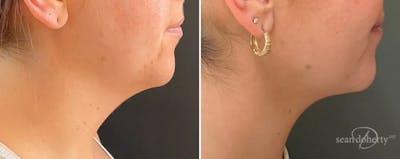 Neck Liposuction Before & After Gallery - Patient 346077 - Image 1