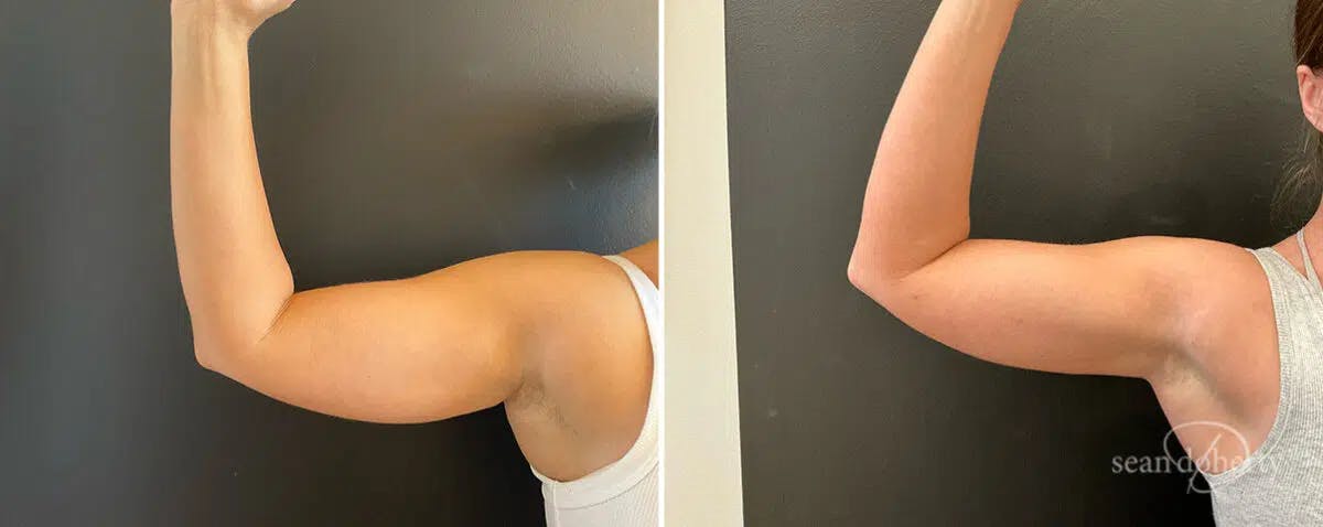 Liposuction Before & After Gallery - Patient 344750 - Image 3