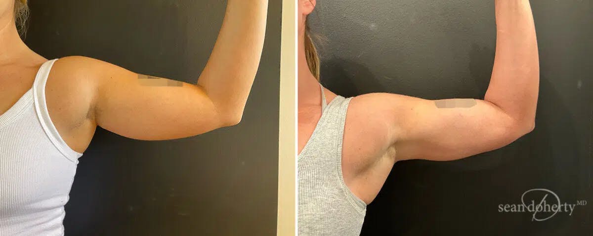 Liposuction Before & After Gallery - Patient 344750 - Image 1