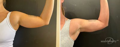 Liposuction Before & After Gallery - Patient 344750 - Image 1