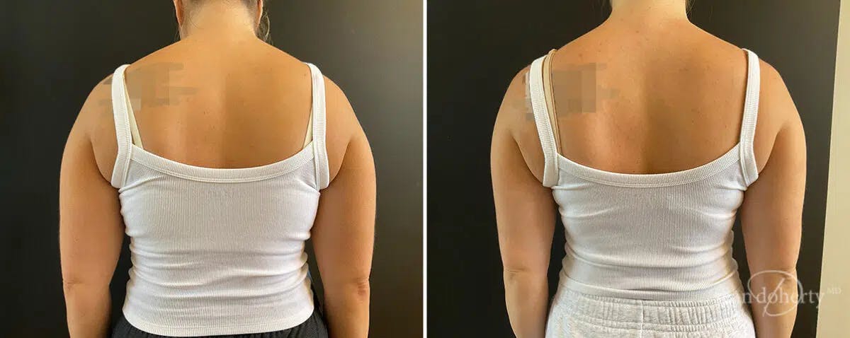 Liposuction Before & After Gallery - Patient 344750 - Image 2