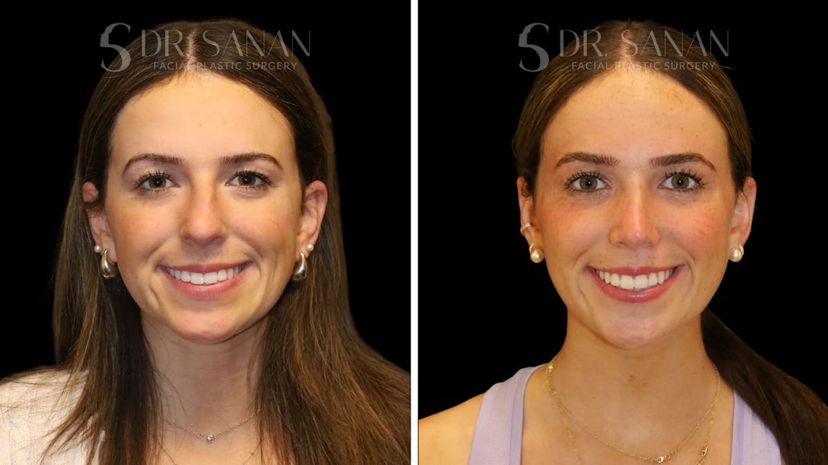Rhinoplasty Before & After Gallery - Patient 388177 - Image 3