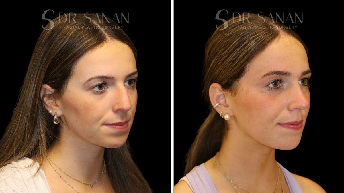 Rhinoplasty Before & After Gallery - Patient 388177 - Image 4