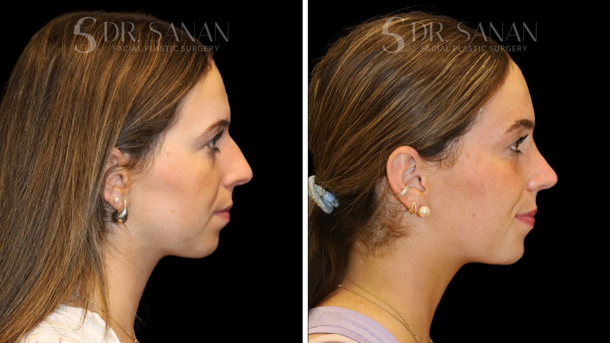 Rhinoplasty Before & After Gallery - Patient 388177 - Image 2