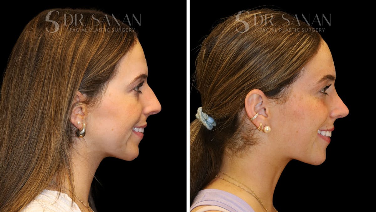 Rhinoplasty Before & After Gallery - Patient 388177 - Image 1