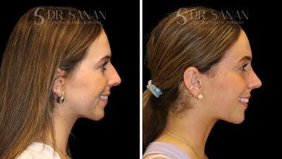 Rhinoplasty Before & After Gallery - Patient 388177 - Image 1