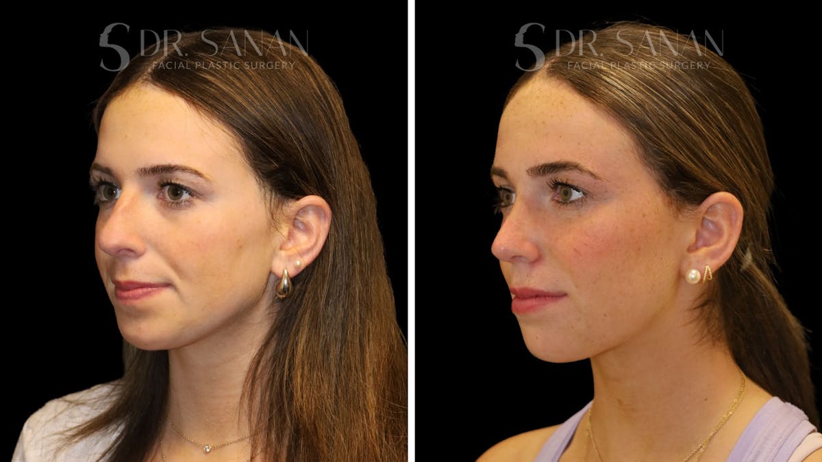 Rhinoplasty Before & After Gallery - Patient 388177 - Image 5