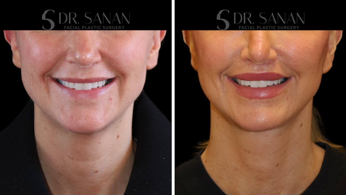 Lip Lift Before & After Gallery - Patient 303021 - Image 1