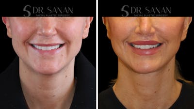 Lip Lift Before & After Gallery - Patient 303021 - Image 1